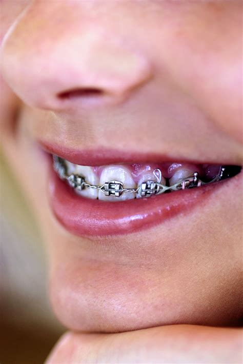 how to know if your braces are fake